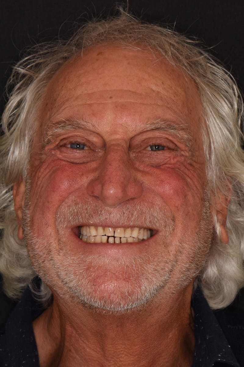 Patient Smile Before & After Gallery - Patient 435988 - Image 1