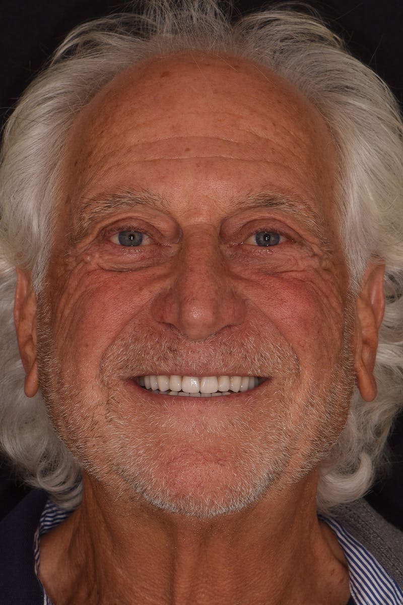 Patient Smile Before & After Gallery - Patient 435988 - Image 2