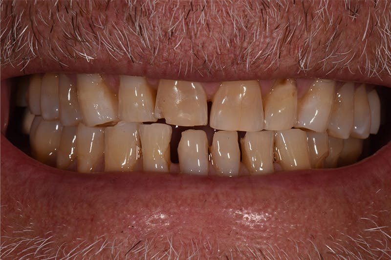 Patient Smile Before & After Gallery - Patient 435988 - Image 3
