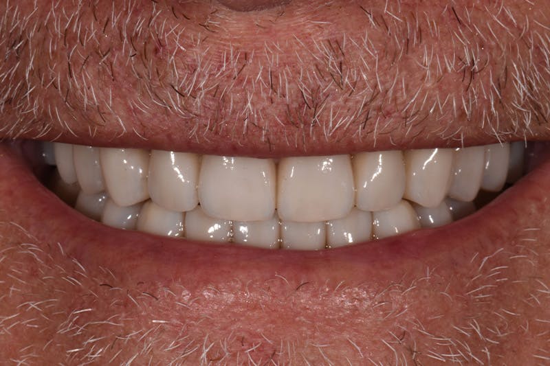 Patient Smile Before & After Gallery - Patient 435988 - Image 4