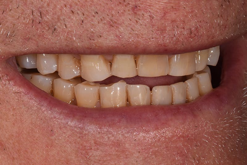 Patient Smile Before & After Gallery - Patient 435988 - Image 5