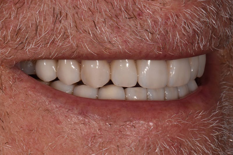 Patient Smile Before & After Gallery - Patient 435988 - Image 6