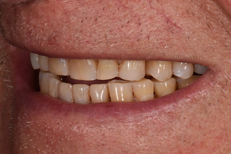 Patient Smile Before & After Gallery - Patient 435988 - Image 7