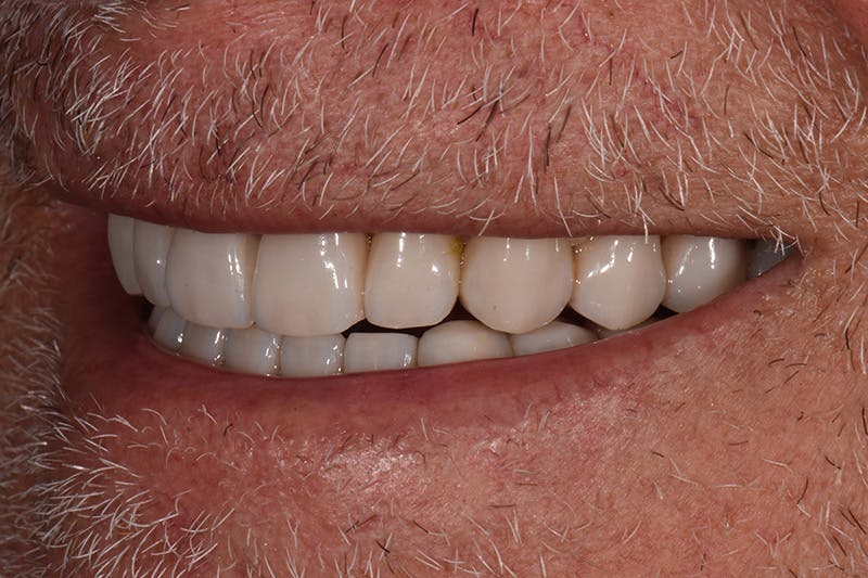 Patient Smile Before & After Gallery - Patient 435988 - Image 8