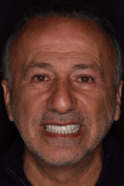 Patient Smile Before & After Gallery - Patient 103912 - Image 2