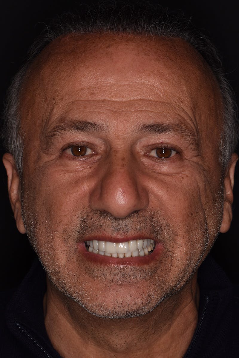 Patient Smile Before & After Gallery - Patient 103912 - Image 2