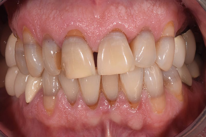 Patient Smile Before & After Gallery - Patient 103912 - Image 3