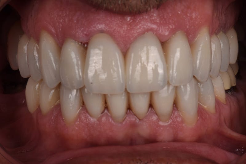 Patient Smile Before & After Gallery - Patient 103912 - Image 4