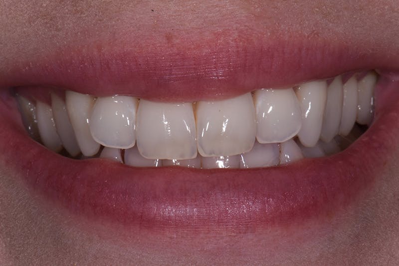 Patient Smile Before & After Gallery - Patient 333470 - Image 3