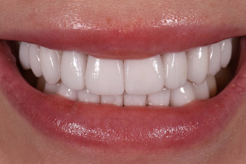 Patient Smile Before & After Gallery - Patient 333470 - Image 4