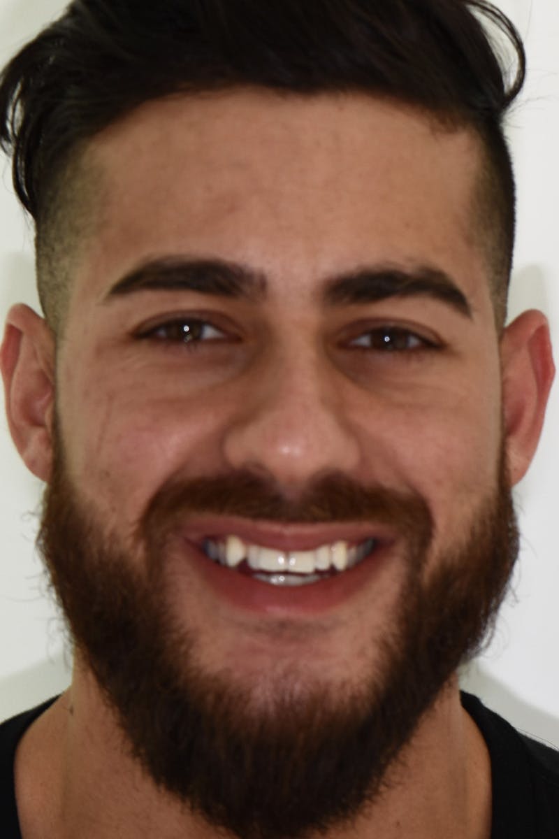 Patient Smile Before & After Gallery - Patient 342937 - Image 1
