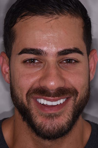 Patient Smile Before & After Gallery - Patient 342937 - Image 2