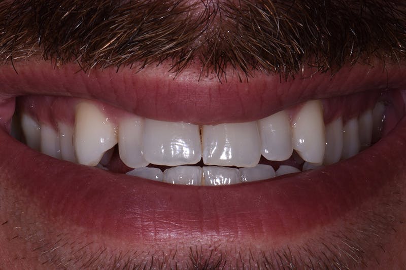Patient Smile Before & After Gallery - Patient 342937 - Image 3