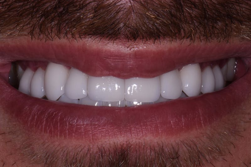 Patient Smile Before & After Gallery - Patient 342937 - Image 4