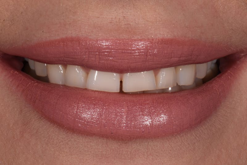 Patient Smile Before & After Gallery - Patient 315517 - Image 3