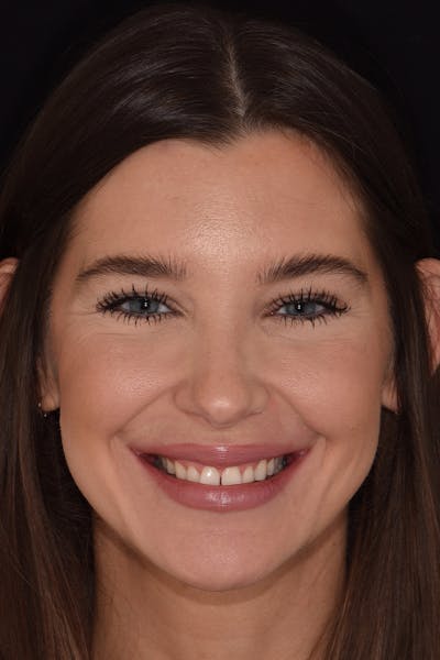 Patient Smile Before & After Gallery - Patient 315517 - Image 1
