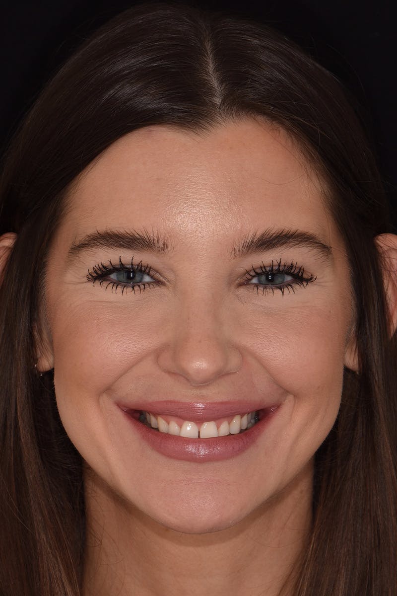 Patient Smile Before & After Gallery - Patient 315517 - Image 1