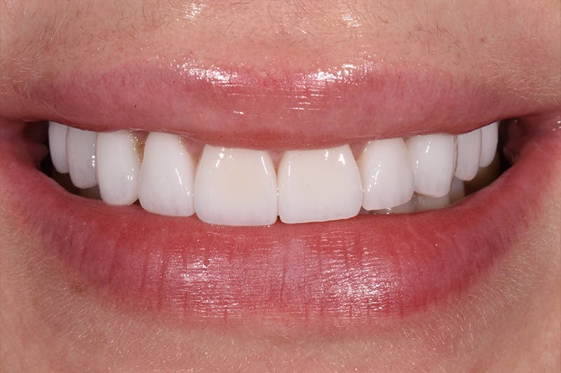 Patient Smile Before & After Gallery - Patient 315517 - Image 4