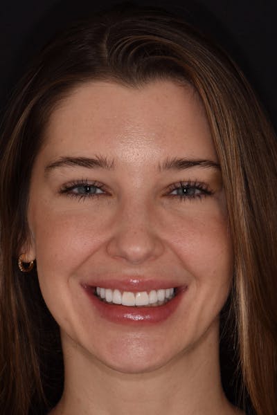 Patient Smile Before & After Gallery - Patient 315517 - Image 2