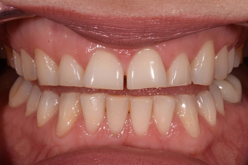 Patient Smile Before & After Gallery - Patient 315517 - Image 5