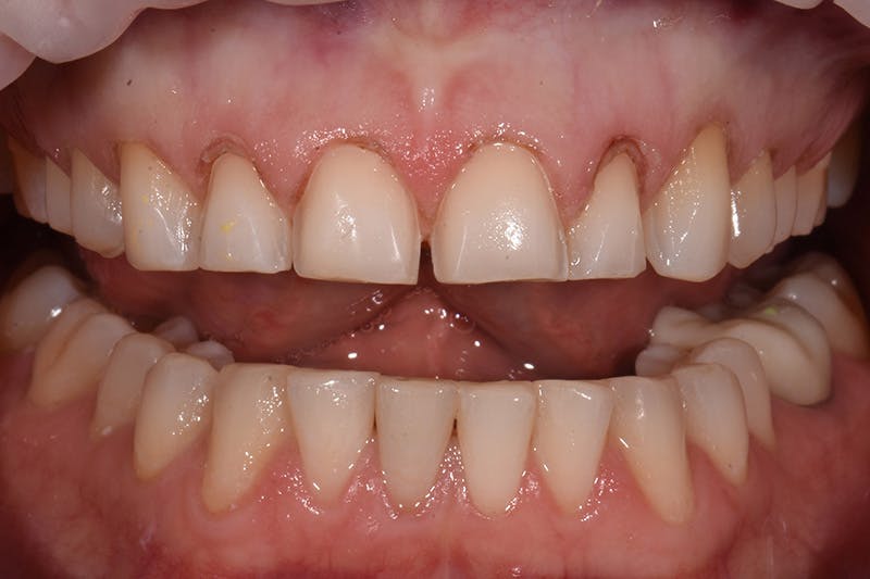 Patient Smile Before & After Gallery - Patient 315517 - Image 6
