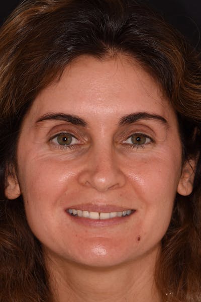Patient Smile Before & After Gallery - Patient 842845 - Image 1