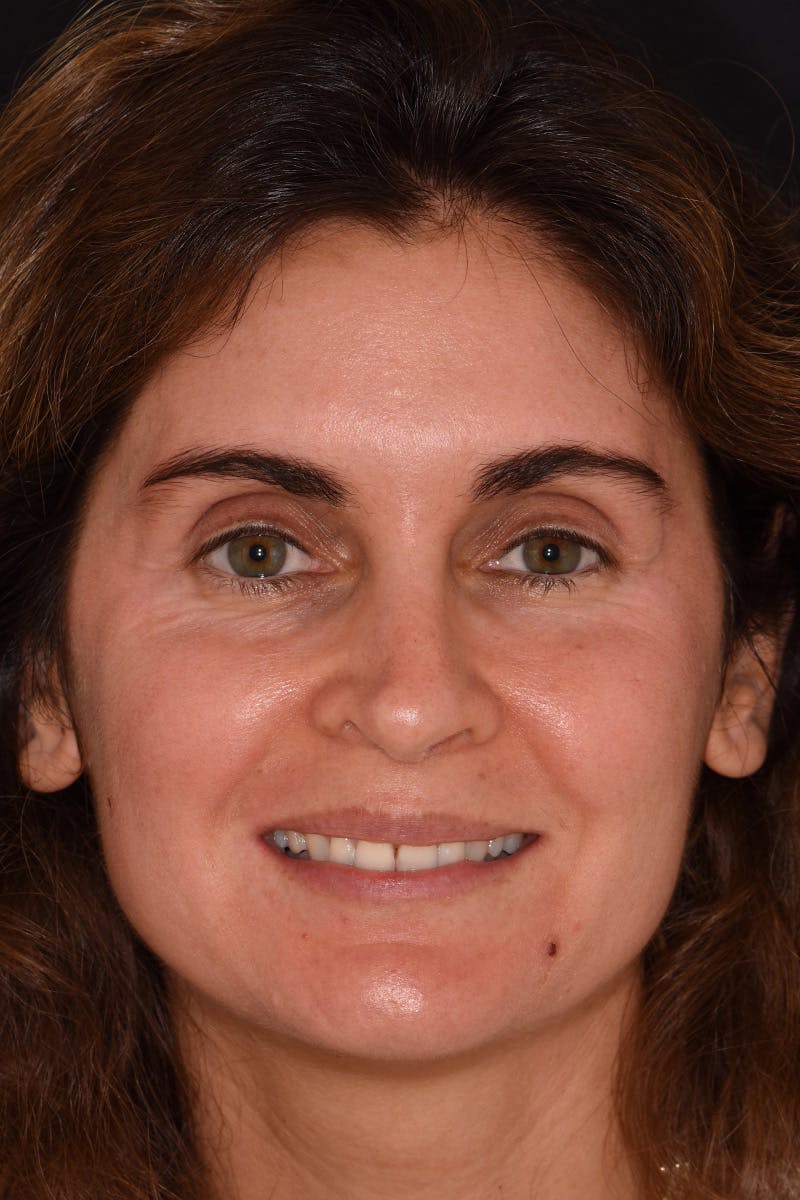 Patient Smile Before & After Gallery - Patient 842845 - Image 1