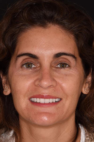 Patient Smile Before & After Gallery - Patient 842845 - Image 2