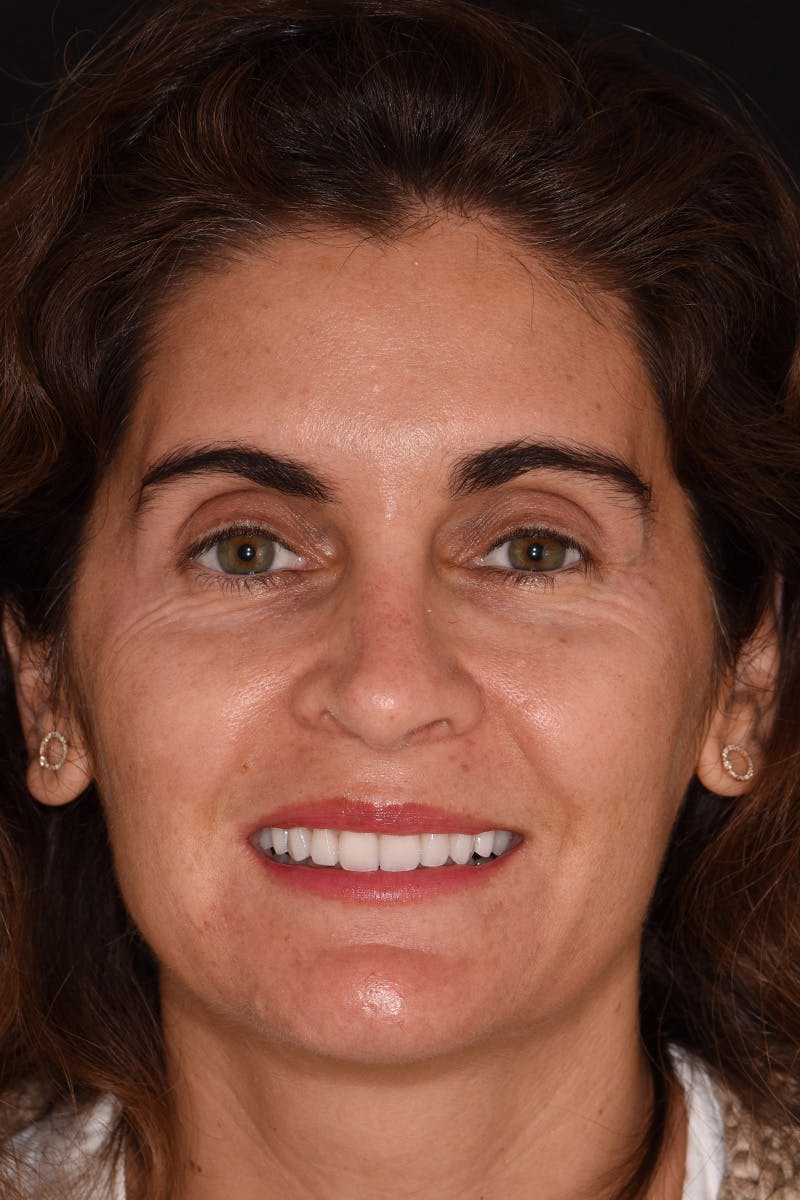Patient Smile Before & After Gallery - Patient 842845 - Image 2