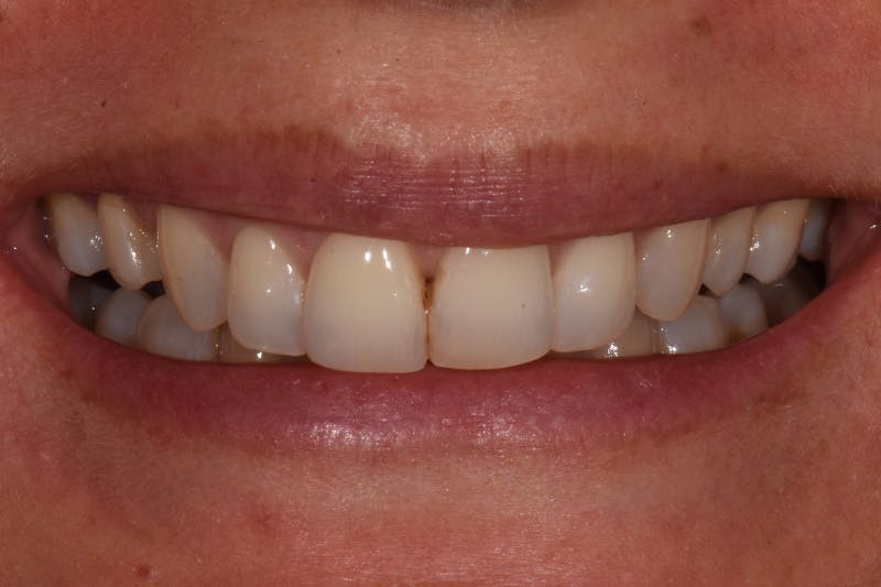 Patient Smile Before & After Gallery - Patient 842845 - Image 3