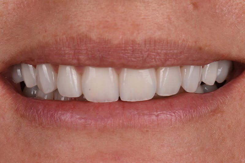 Patient Smile Before & After Gallery - Patient 842845 - Image 4