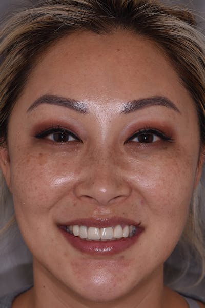 Patient Smile Before & After Gallery - Patient 114108 - Image 1