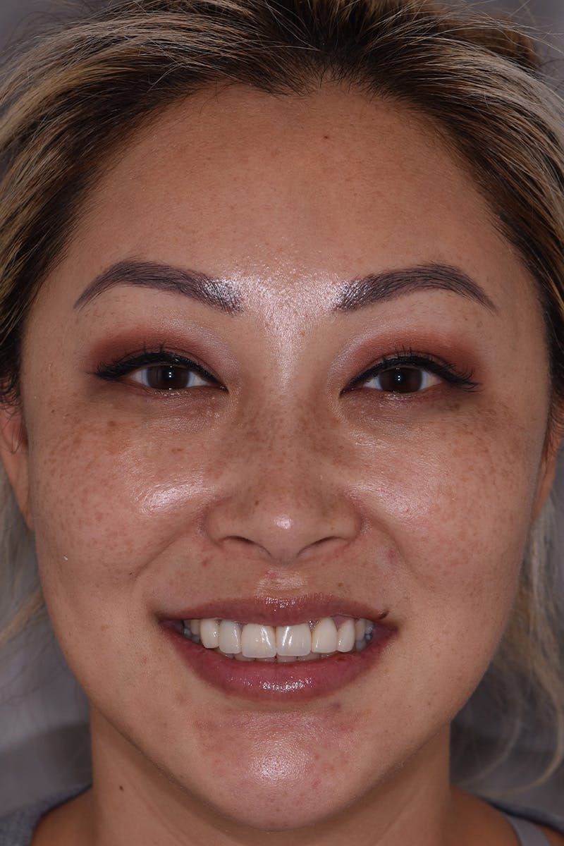 Patient Smile Before & After Gallery - Patient 114108 - Image 1