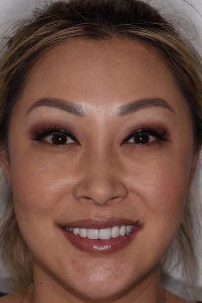 Patient Smile Before & After Gallery - Patient 114108 - Image 2