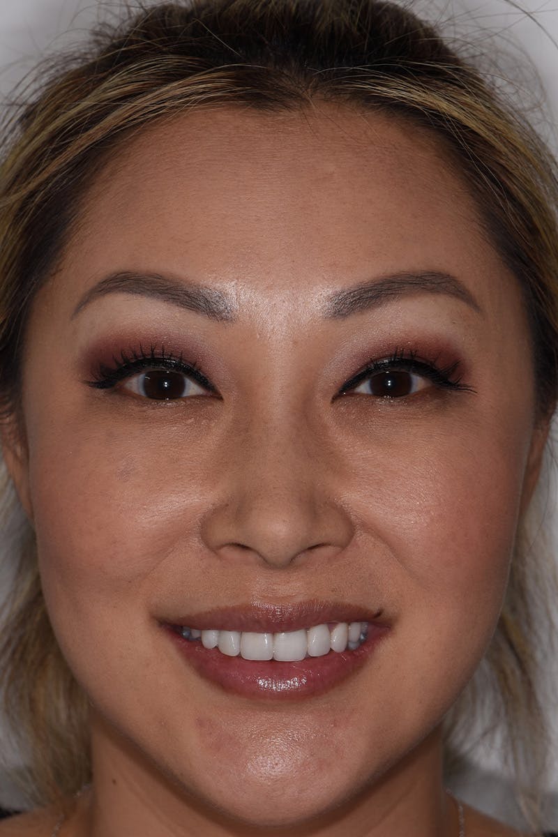 Patient Smile Before & After Gallery - Patient 114108 - Image 2