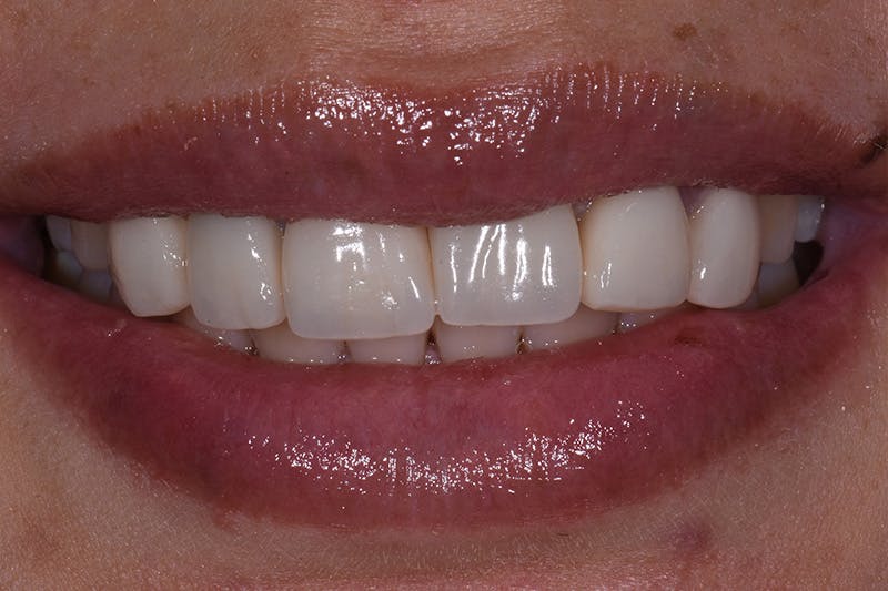 Patient Smile Before & After Gallery - Patient 114108 - Image 3