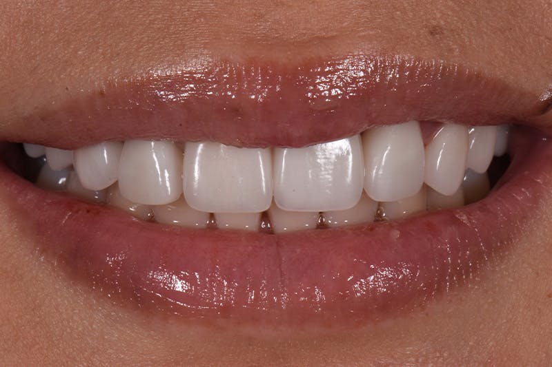 Patient Smile Before & After Gallery - Patient 114108 - Image 4
