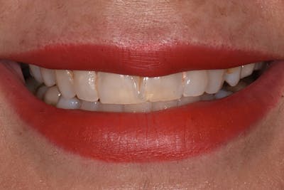 Patient Smile Before & After Gallery - Patient 729581 - Image 1