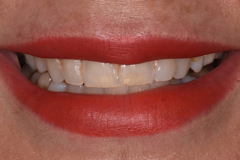 Patient Smile Before & After Gallery - Patient 729581 - Image 1