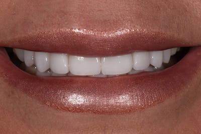 Patient Smile Before & After Gallery - Patient 729581 - Image 2