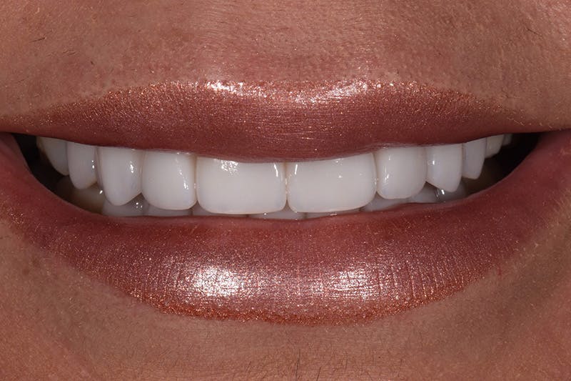Patient Smile Before & After Gallery - Patient 729581 - Image 2