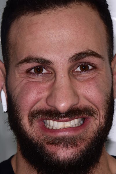 Patient Smile Before & After Gallery - Patient 355151 - Image 1