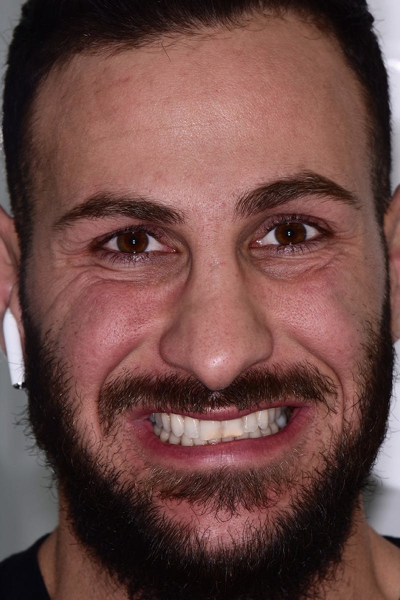 Patient Smile Before & After Gallery - Patient 355151 - Image 1