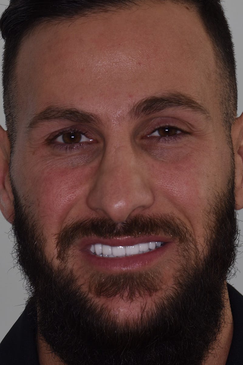 Patient Smile Before & After Gallery - Patient 355151 - Image 2