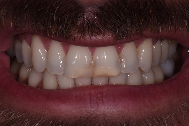 Patient Smile Before & After Gallery - Patient 355151 - Image 3