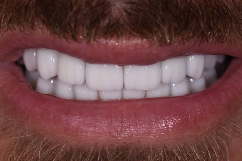Patient Smile Before & After Gallery - Patient 355151 - Image 4