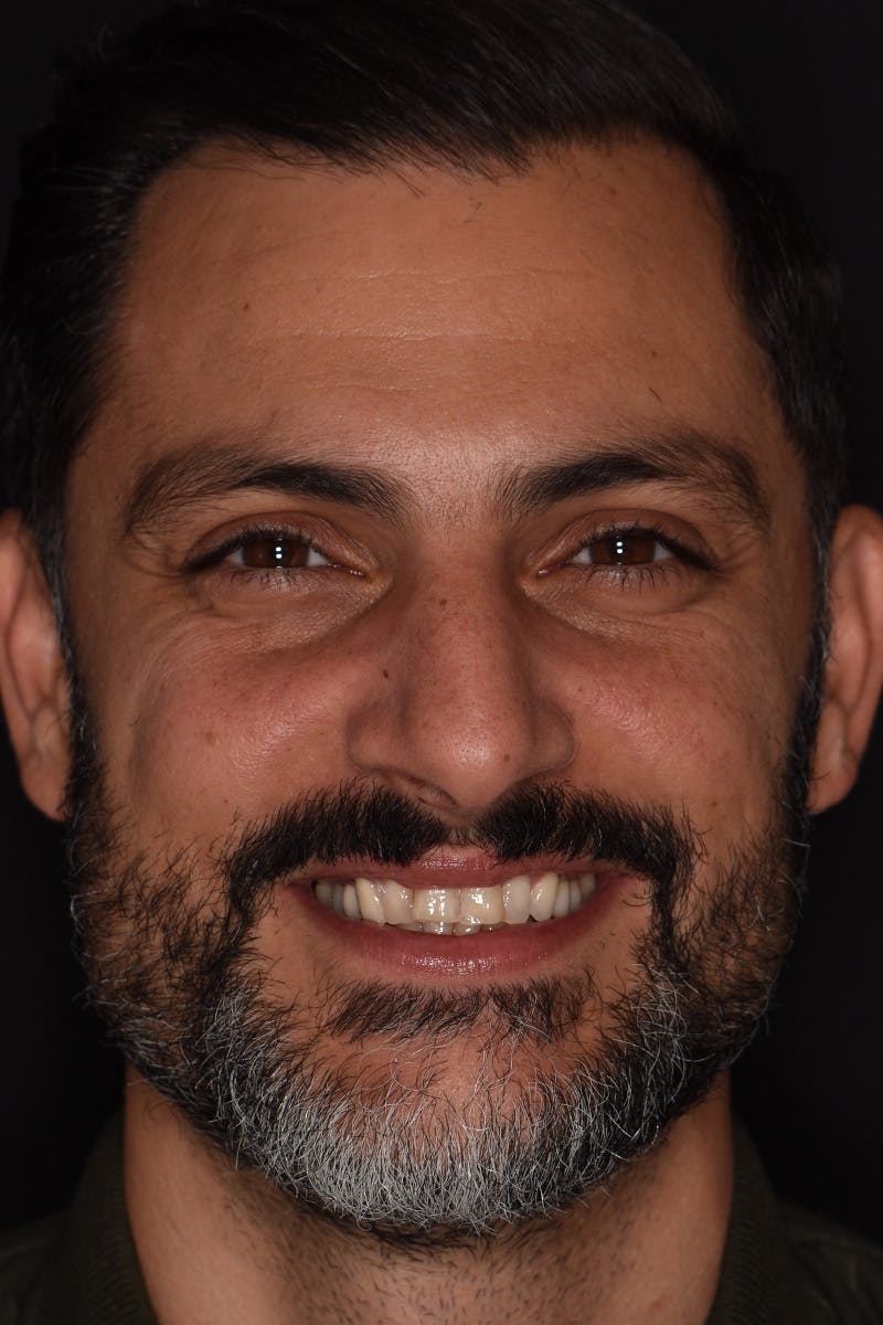 Patient Smile Before & After Gallery - Patient 205656 - Image 1
