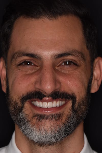 Patient Smile Before & After Gallery - Patient 205656 - Image 2