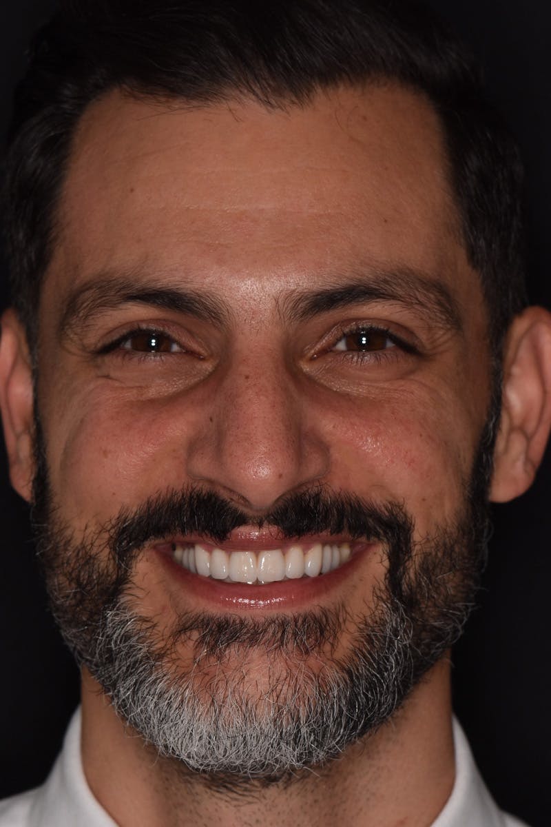 Patient Smile Before & After Gallery - Patient 205656 - Image 2