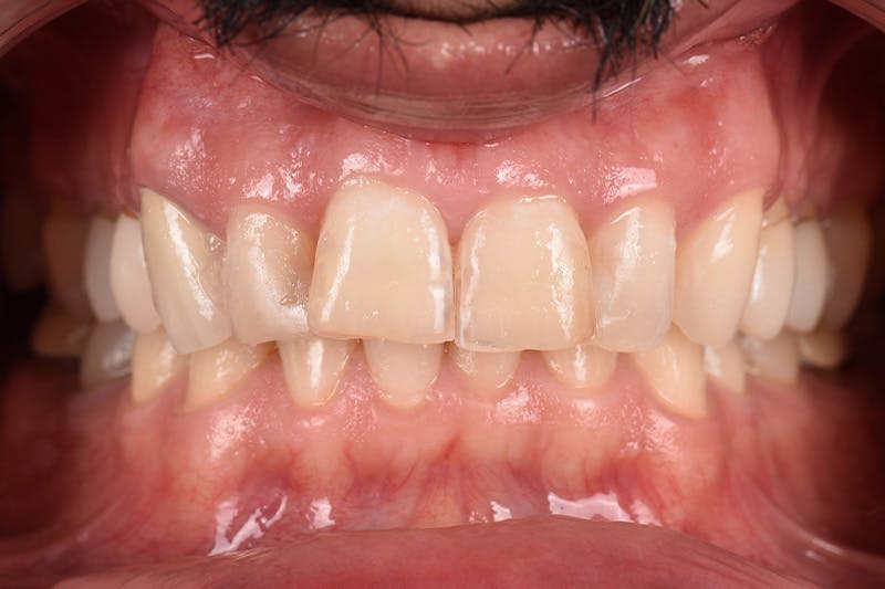 Patient Smile Before & After Gallery - Patient 205656 - Image 3